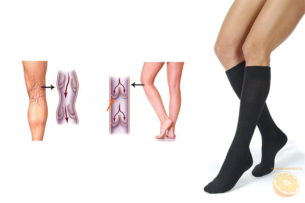 12,99 € Kompresinės kojinės nuo varikozės